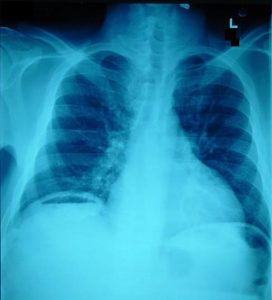 pneumoperitoneum_x-ray-600x662